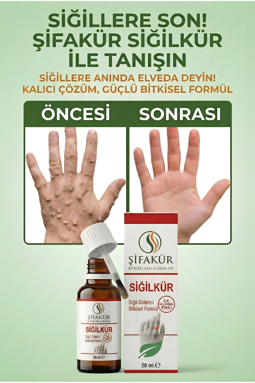 Siğilkür Siğil Giderici Bitkisel Solüsyon 20ml - Törpü ve Koruyucu Pedli Tam Bakım Seti
