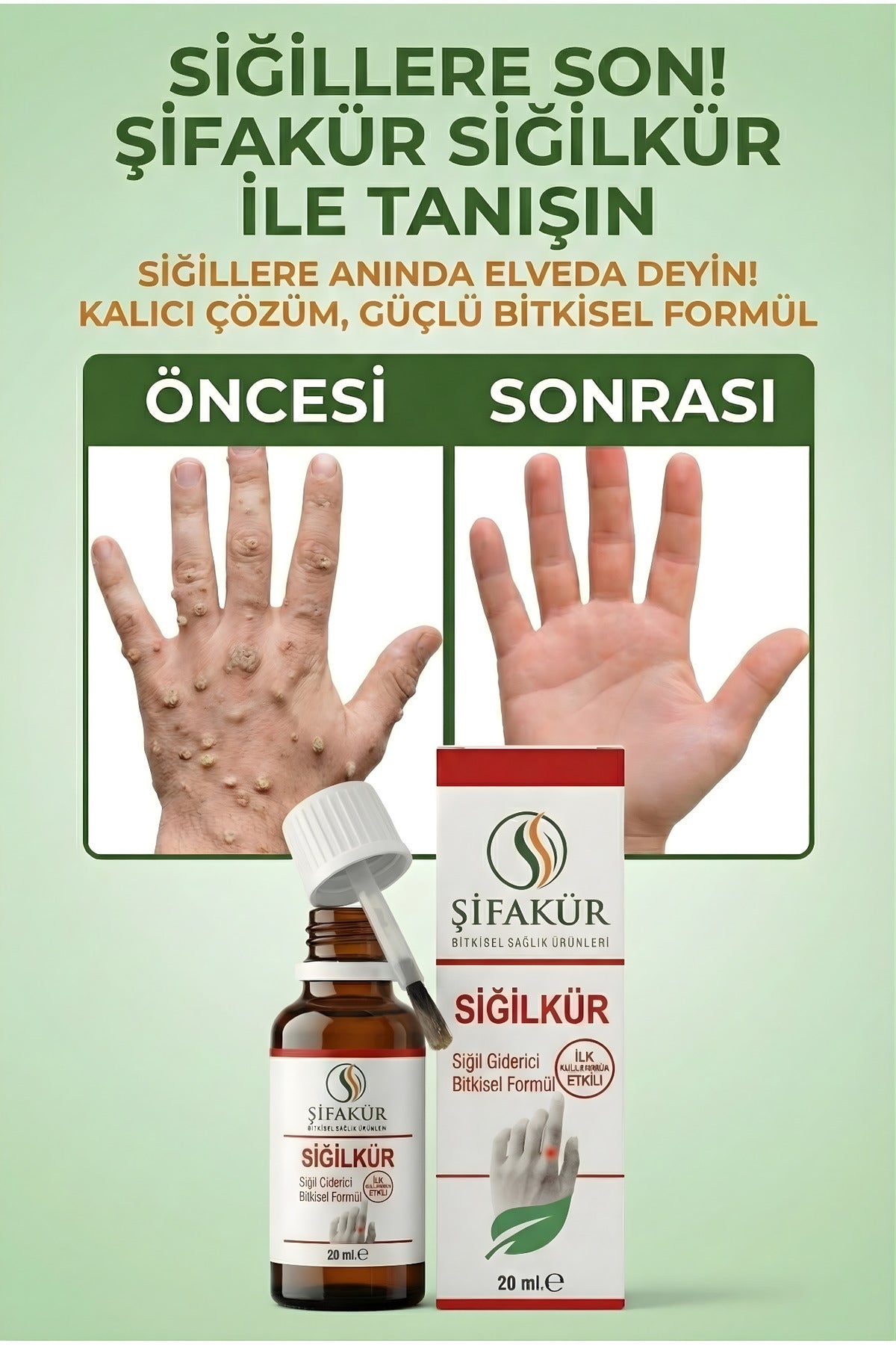 Siğilkür Siğil Giderici Bitkisel Solüsyon 20ml - Törpü ve Koruyucu Pedli Tam Bakım Seti